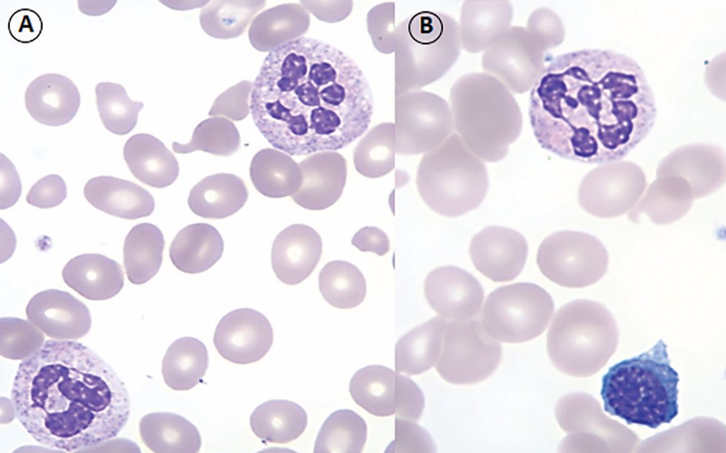 Megaloblastic Anemia And Pernicious Anemia